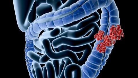 colon cancer treatment