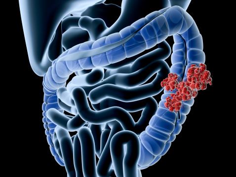 colon cancer treatment