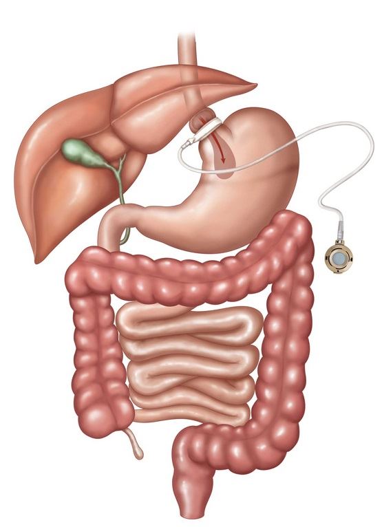 gastric banding surgery