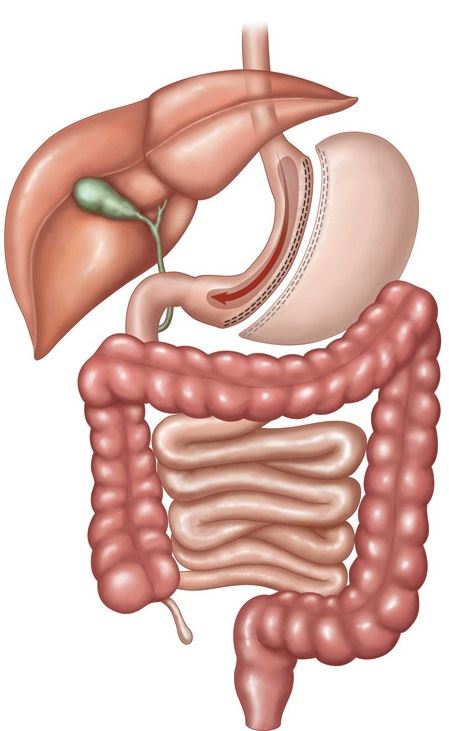 gastric sleeve surgery