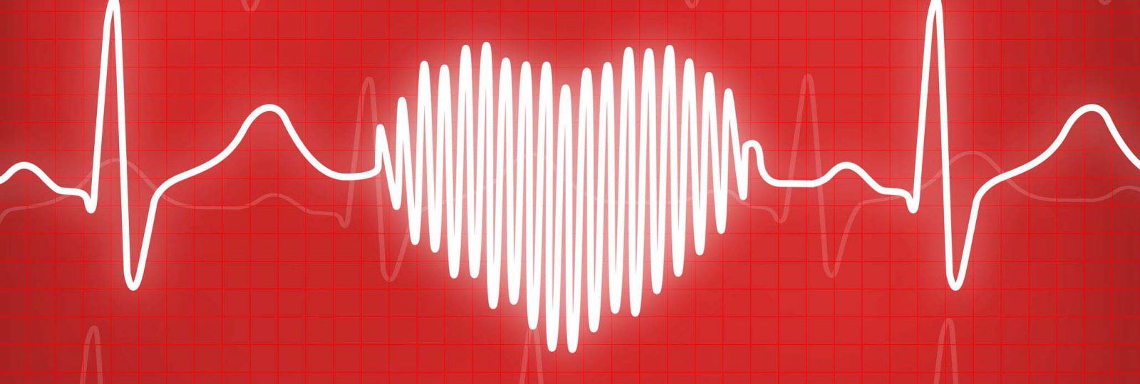Leon's Cardiac Catheterization Detects 90 Blockage CentraState