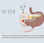 A Complex, Lifesaving Surgery for Pancreatic Cancer