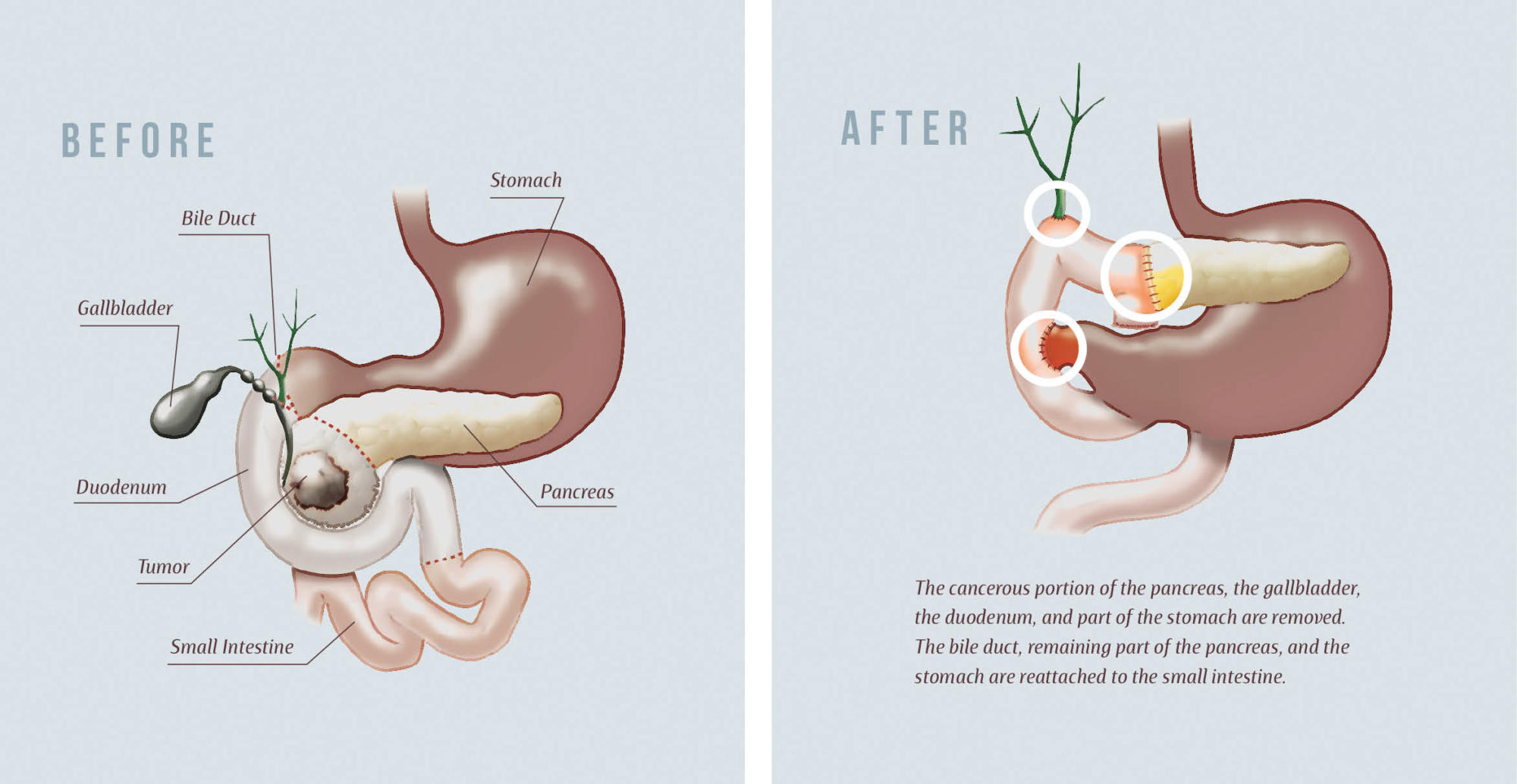 pancreas cancer